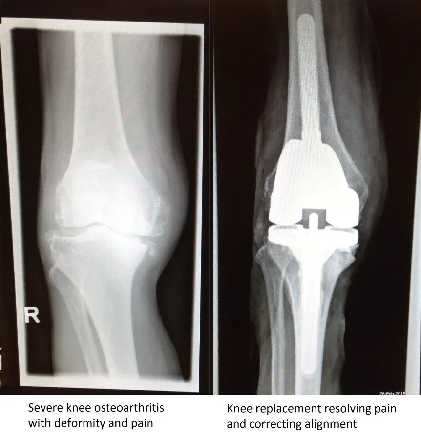 Knee Osteoarthritis