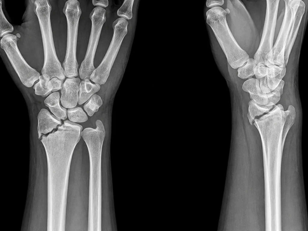 X-ray wrist