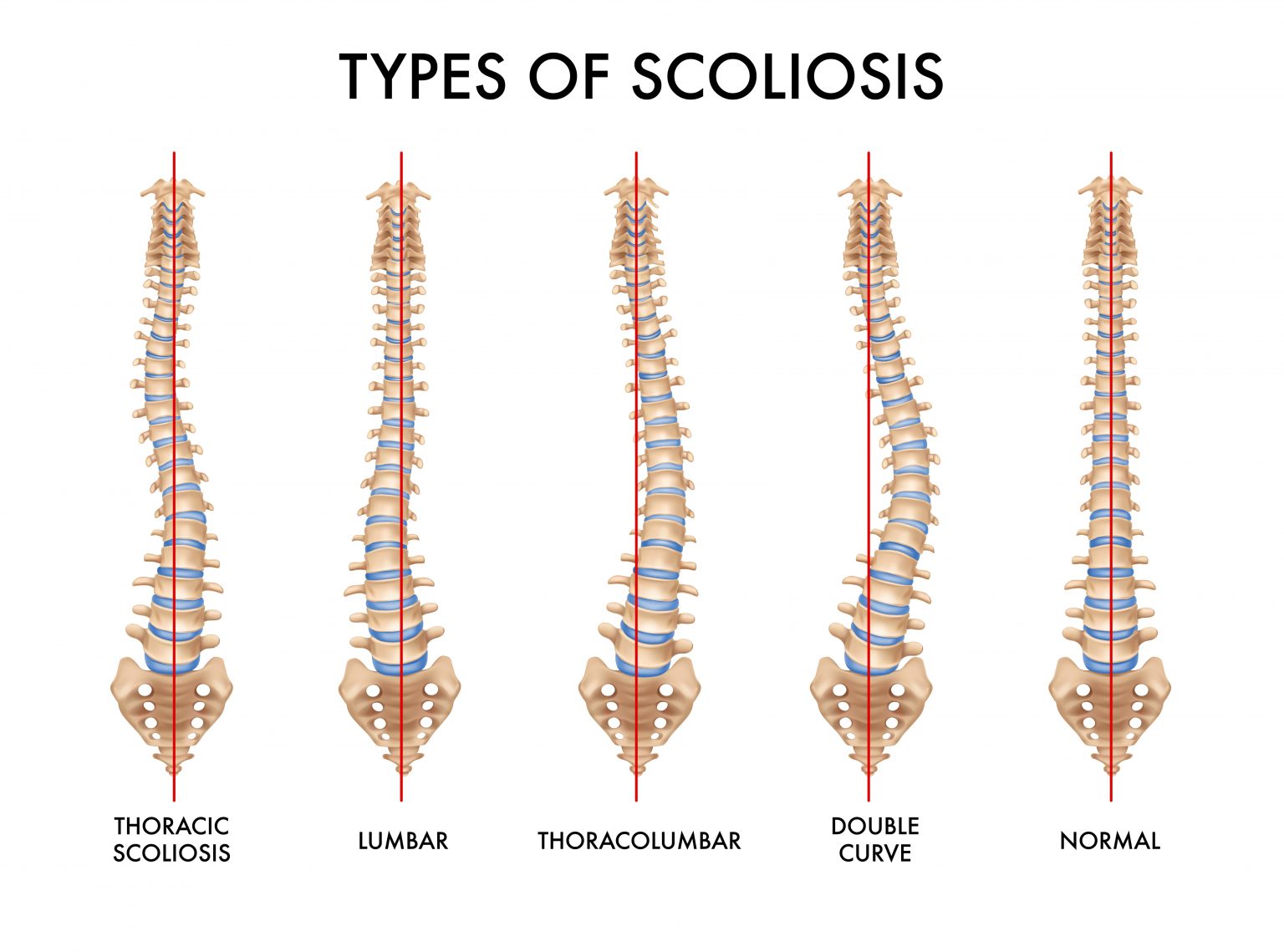 Scoliosis - Symptoms, Types and Causes - Island Orthopaedics